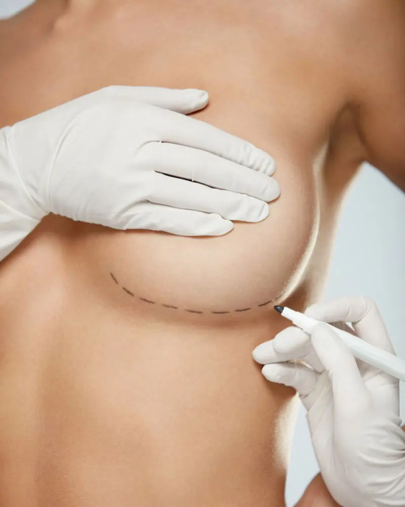 Breast Augmentation