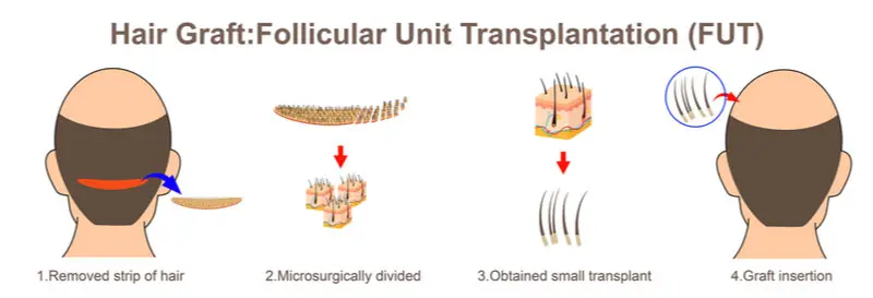 Scarless Follicular Hair Transplant