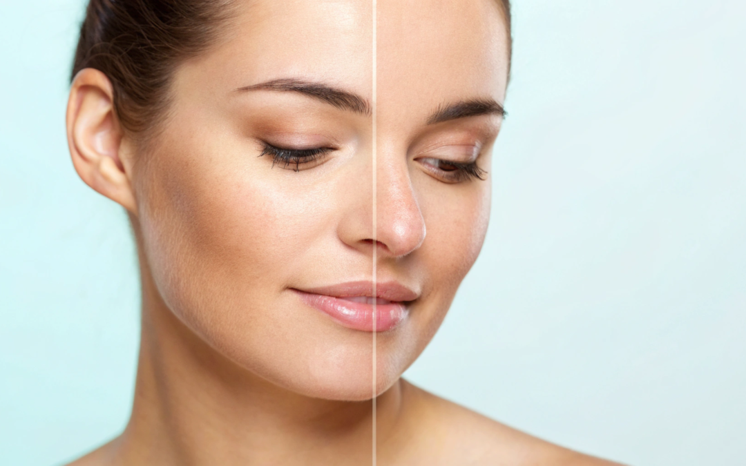 CO2 Laser Skin Resurfacing: What to Expect