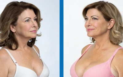 Your Guide to Fat Transfer Breast Augmentation